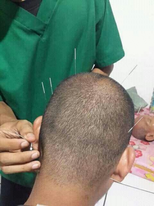 akupunktur kasus gangguan jiwa